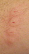 Puncture Marks