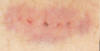 Puncture Marks